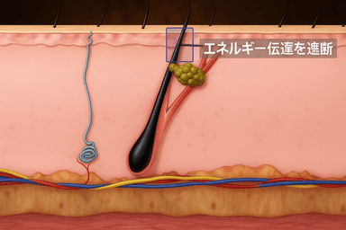 アクネハンドピース