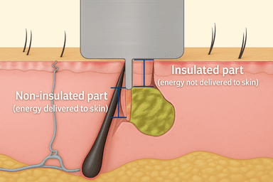 Insulated Needle
