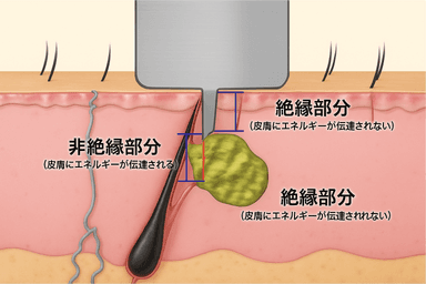絶縁ニードル