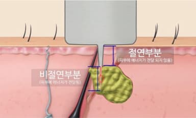 절연된 니들