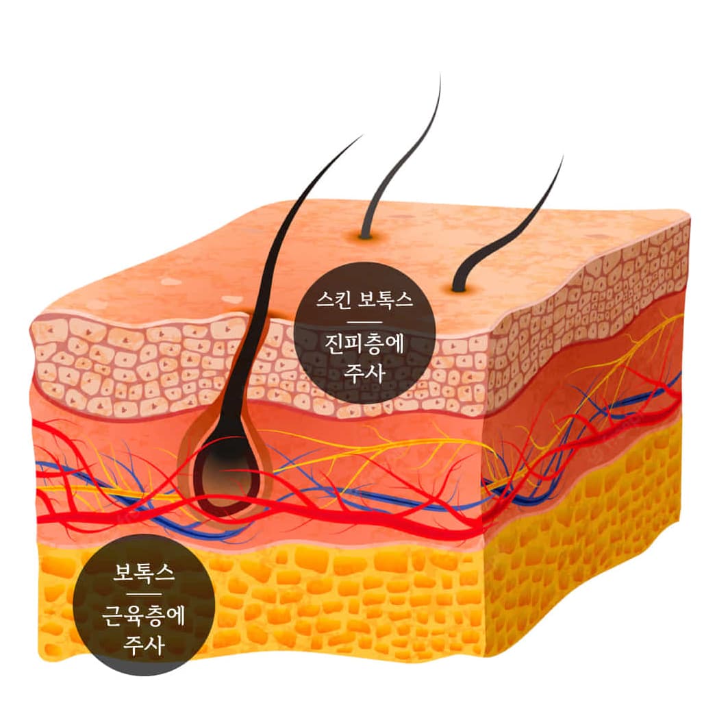 Step undefined: Traditional Botox